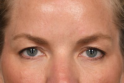 Blepharoplasty Before & After Gallery - Patient 173920904 - Image 1