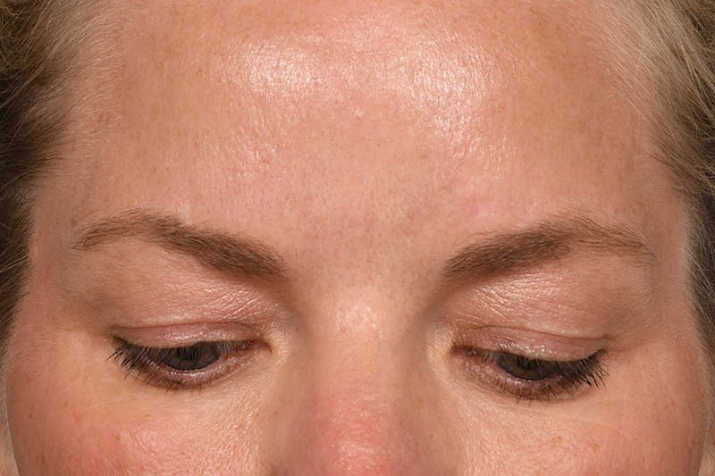 Blepharoplasty Before & After Gallery - Patient 173920904 - Image 3