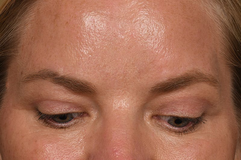Blepharoplasty Before & After Gallery - Patient 173920904 - Image 4