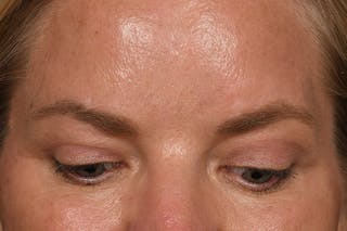 Blepharoplasty Before & After Gallery - Patient 173920904 - Image 4
