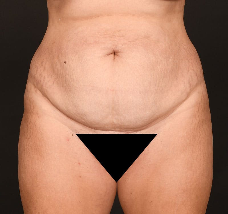 Tummy Tuck Before & After Gallery - Patient 183321077 - Image 1