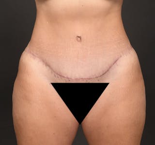 Tummy Tuck Before & After Gallery - Patient 183321077 - Image 2