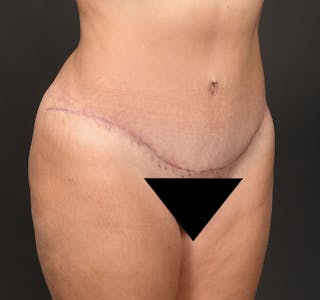 Tummy Tuck Before & After Gallery - Patient 183321077 - Image 10