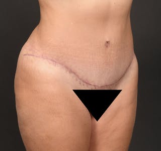 Liposuction Before & After Gallery - Patient 183321078 - Image 10