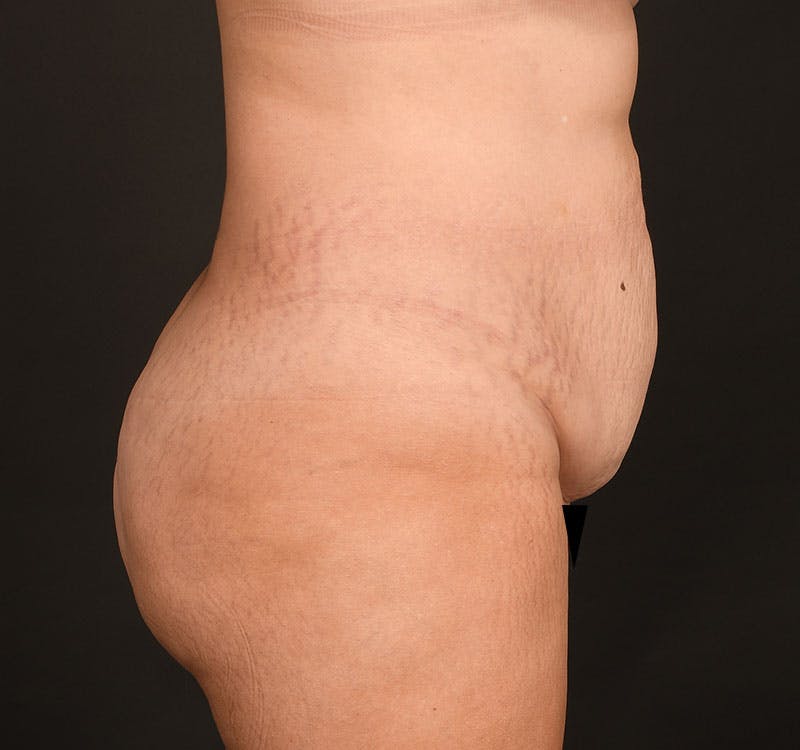 Tummy Tuck Before & After Gallery - Patient 183321077 - Image 7
