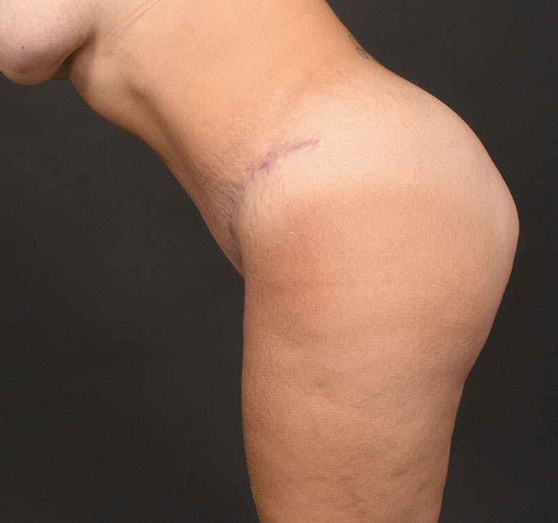 Liposuction Before & After Gallery - Patient 183321078 - Image 12