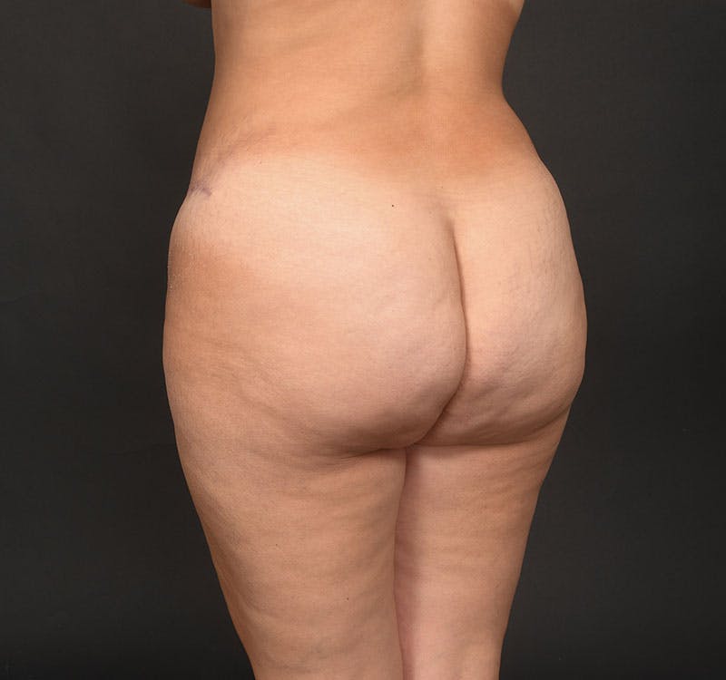 Liposuction Before & After Gallery - Patient 183321078 - Image 16