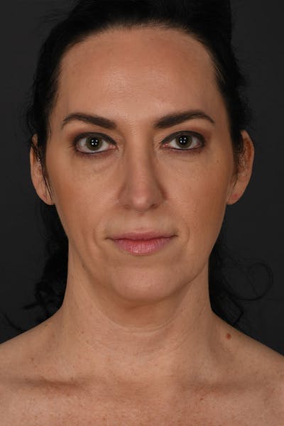 Neck Lift Before & After Gallery - Patient 183321081 - Image 1