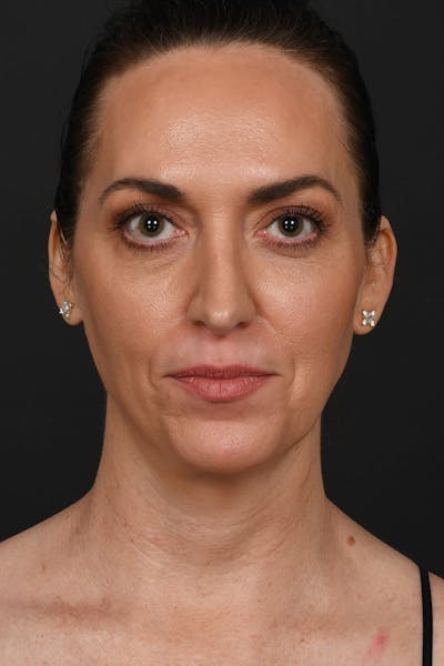 Neck Lift Before & After Gallery - Patient 183321081 - Image 2