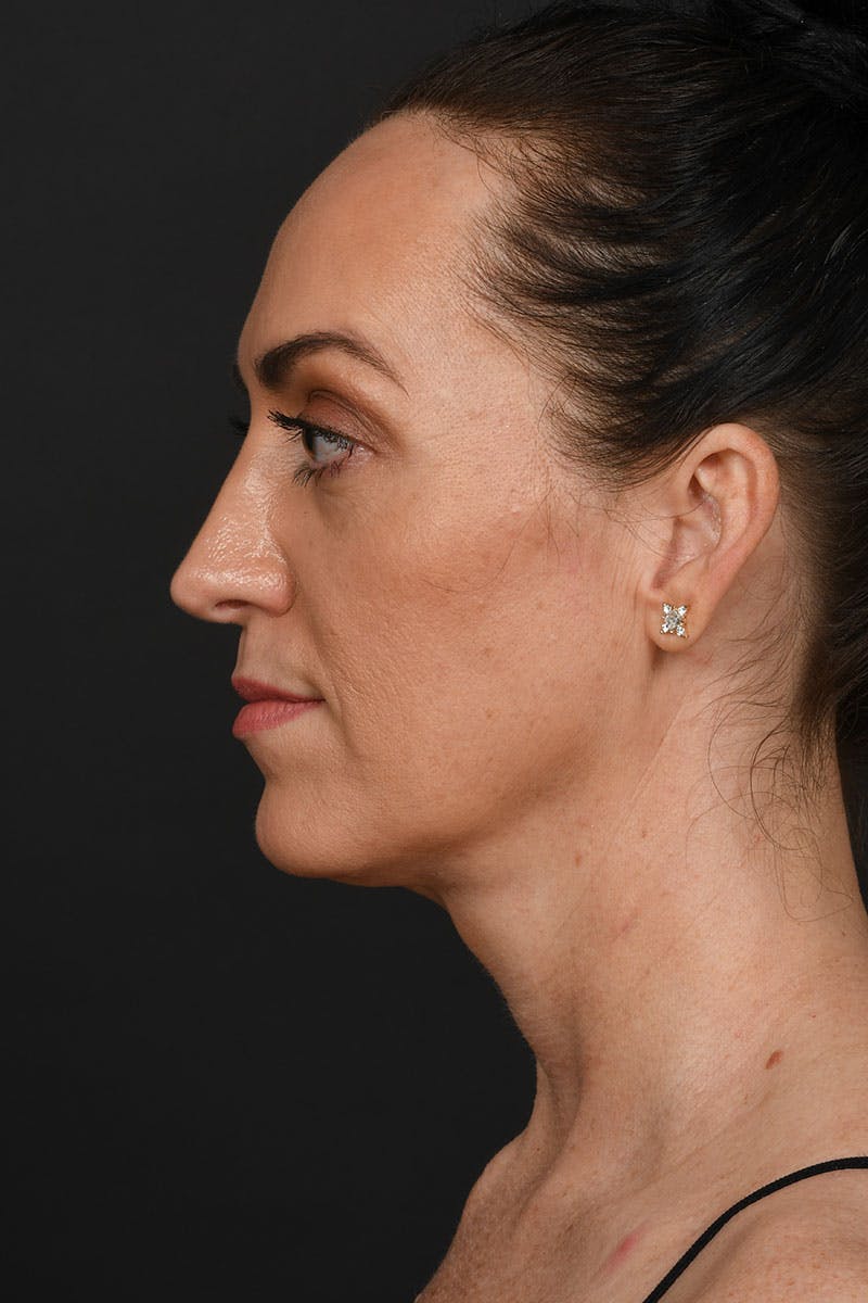 Neck Lift Before & After Gallery - Patient 183321081 - Image 6