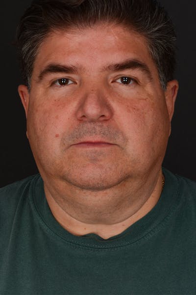 Neck Lift Before & After Gallery - Patient 183321085 - Image 1