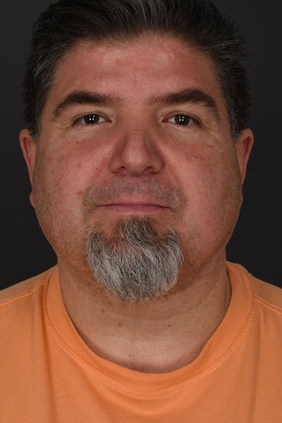 Neck Lift Before & After Gallery - Patient 183321085 - Image 2