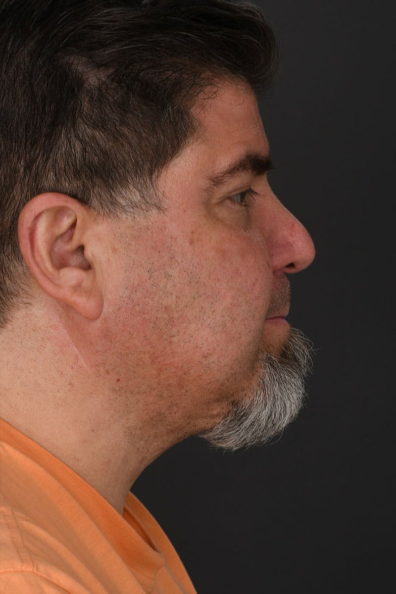 Neck Lift Before & After Gallery - Patient 183321085 - Image 6