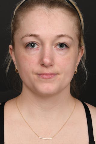 Rhinoplasty Before & After Gallery - Patient 183321099 - Image 4