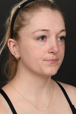 Rhinoplasty Before & After Gallery - Patient 183321099 - Image 8