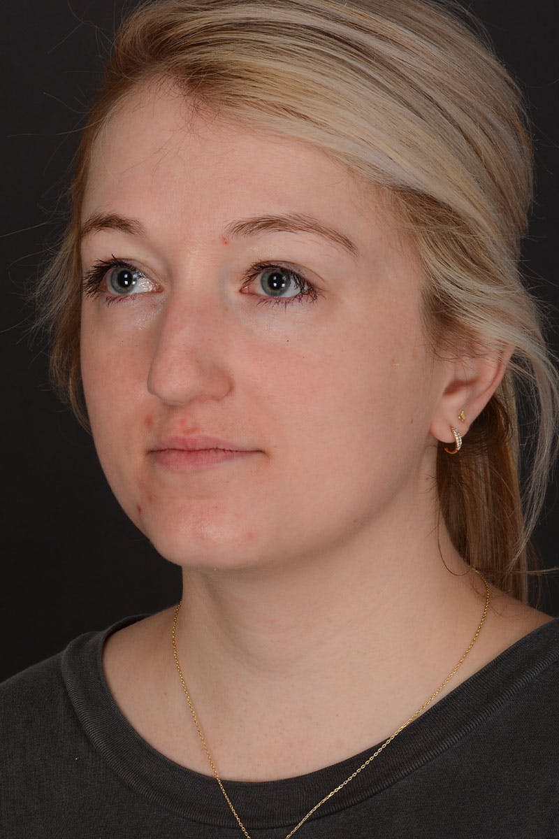 Rhinoplasty Before & After Gallery - Patient 183321099 - Image 7