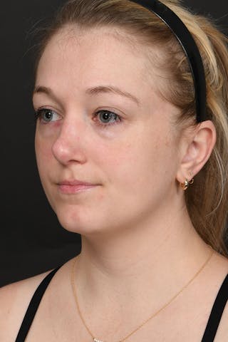 Rhinoplasty Before & After Gallery - Patient 183321099 - Image 6