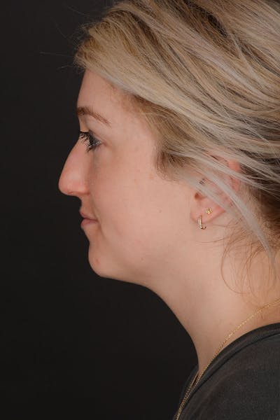 Rhinoplasty Before & After Gallery - Patient 183321099 - Image 1