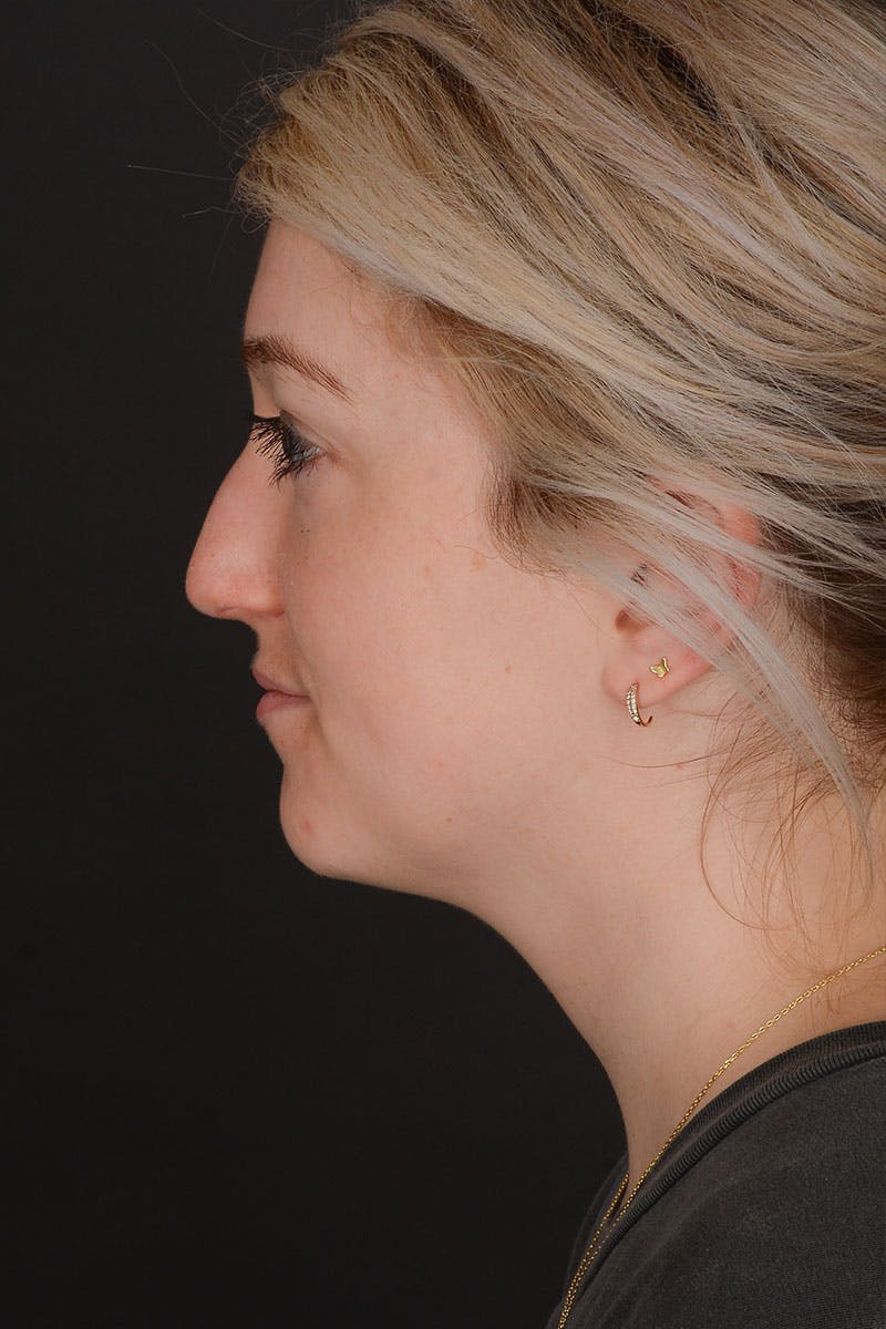 Rhinoplasty Before & After Gallery - Patient 183321099 - Image 11