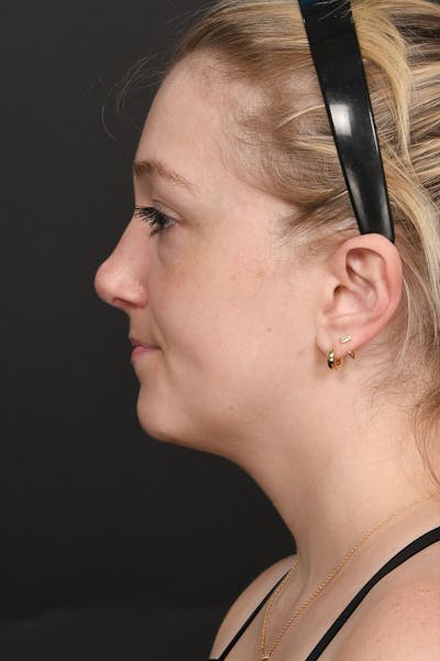 Rhinoplasty Before & After Gallery - Patient 183321099 - Image 2