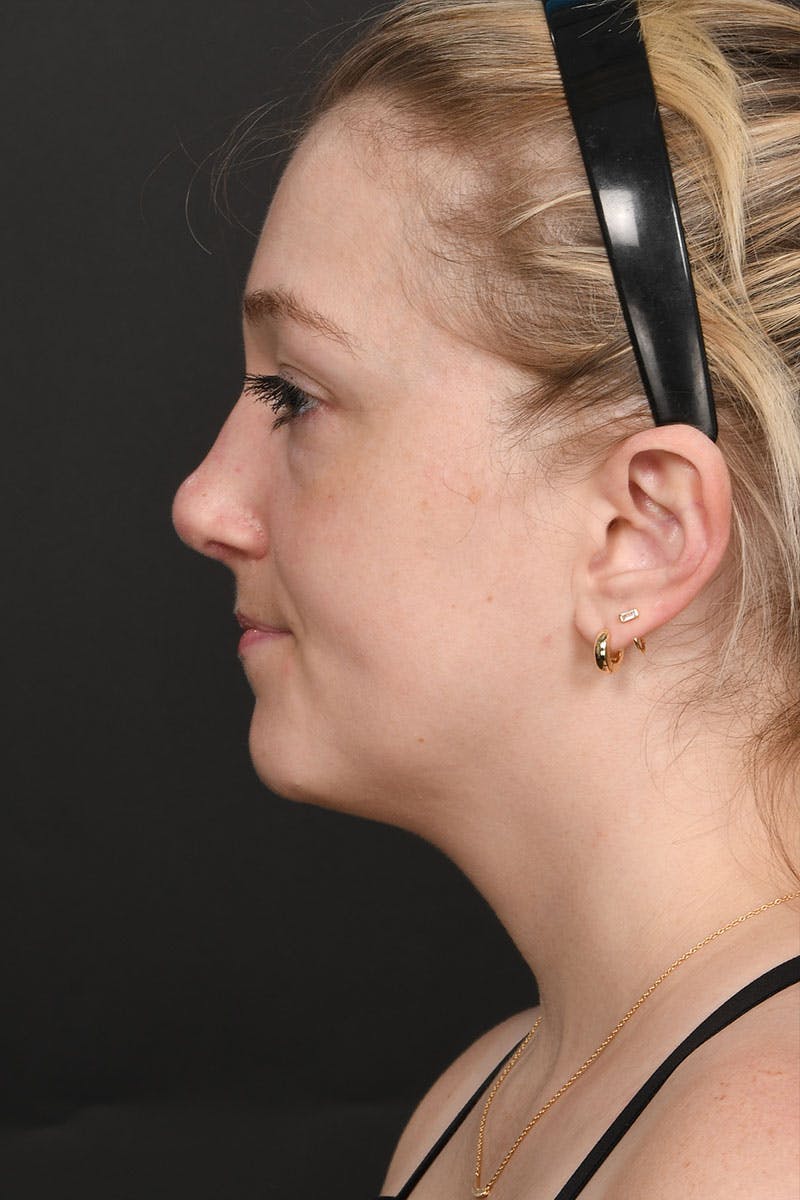 Rhinoplasty Before & After Gallery - Patient 183321099 - Image 2