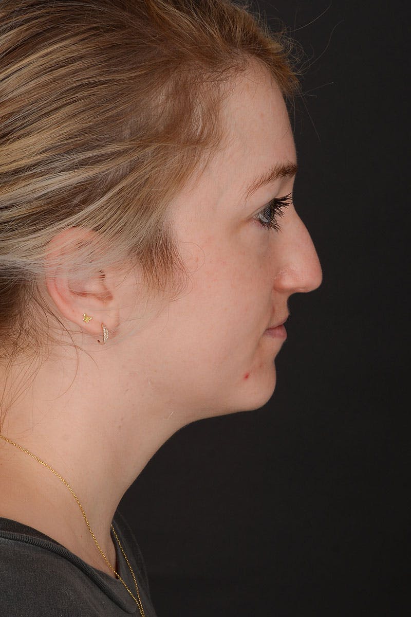 Rhinoplasty Before & After Gallery - Patient 183321099 - Image 9
