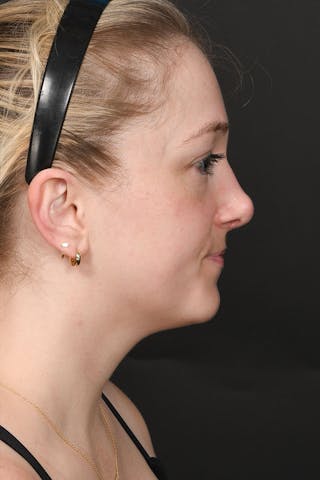 Rhinoplasty Before & After Gallery - Patient 183321099 - Image 12