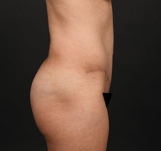 Tummy Tuck Before & After Gallery - Patient 200286655 - Image 6
