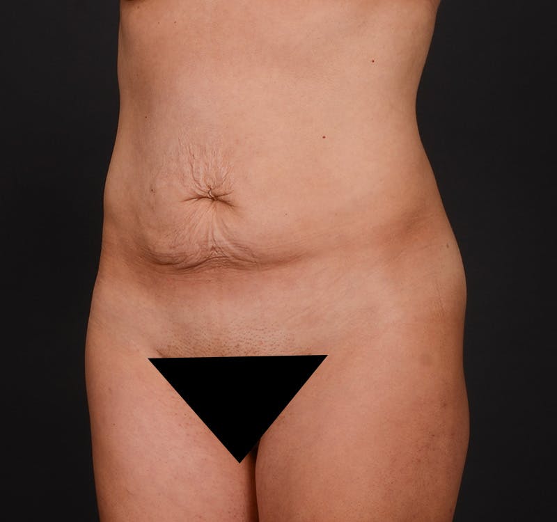Tummy Tuck Before & After Gallery - Patient 200286655 - Image 7