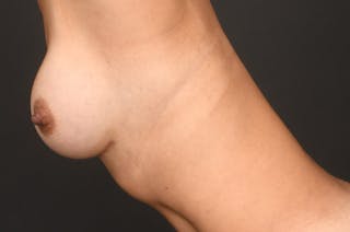 Breast Augmentation Before & After Gallery - Patient 200286900 - Image 10