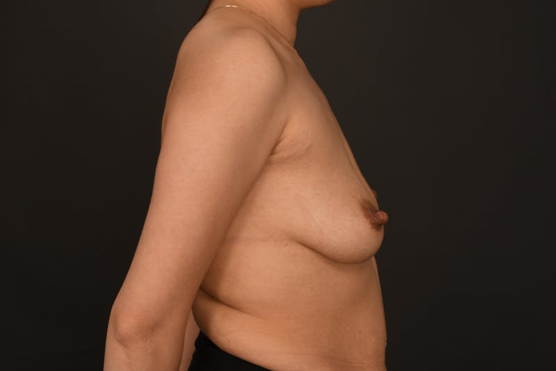 Breast Augmentation Before & After Gallery - Patient 296715 - Image 7