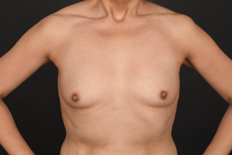 Breast Augmentation Before & After Gallery - Patient 213437 - Image 3