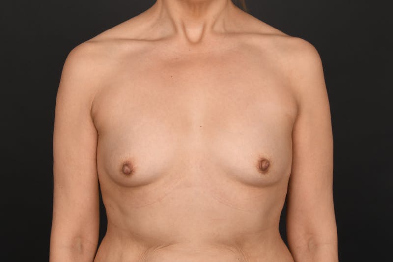 Breast Augmentation Before & After Gallery - Patient 213437 - Image 1