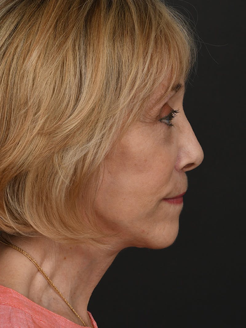 Facelift Before & After Gallery - Patient 315494 - Image 6