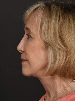 Facelift Before & After Gallery - Patient 315494 - Image 10