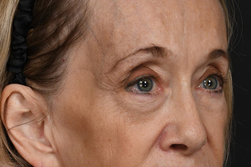 Blepharoplasty Before & After Gallery - Patient 302337 - Image 3
