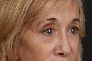 Blepharoplasty Before & After Gallery - Patient 302337 - Image 4