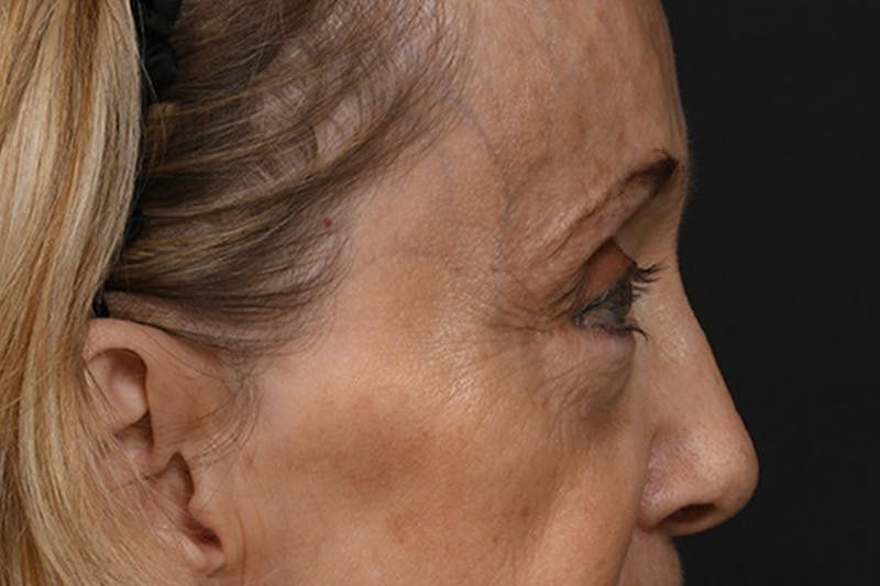 Blepharoplasty Before & After Gallery - Patient 302337 - Image 5