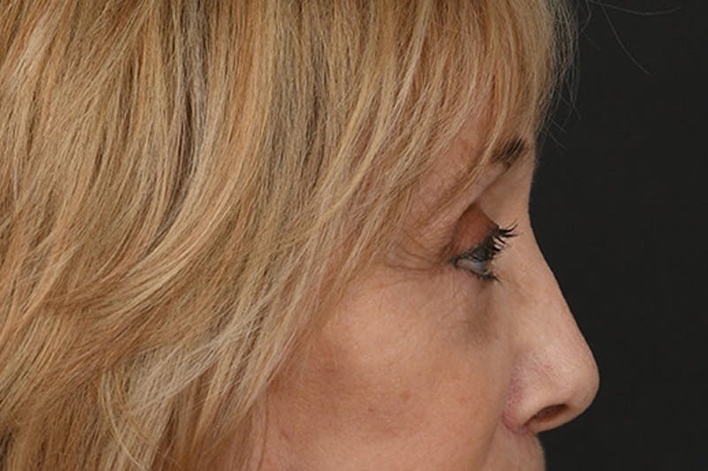 Blepharoplasty Before & After Gallery - Patient 302337 - Image 6