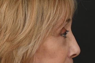 Blepharoplasty Before & After Gallery - Patient 302337 - Image 6