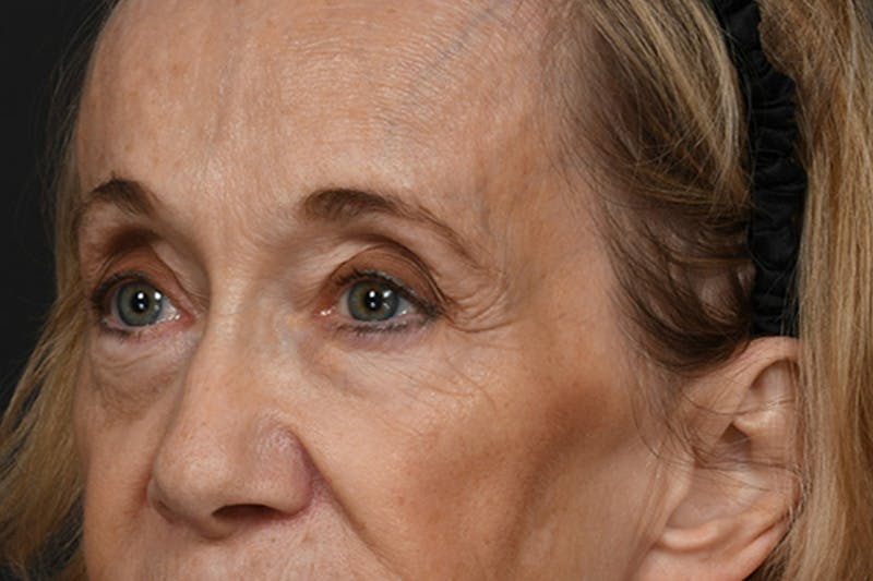 Blepharoplasty Before & After Gallery - Patient 302337 - Image 7