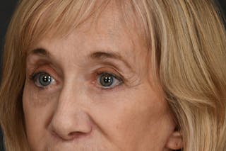 Blepharoplasty Before & After Gallery - Patient 302337 - Image 8