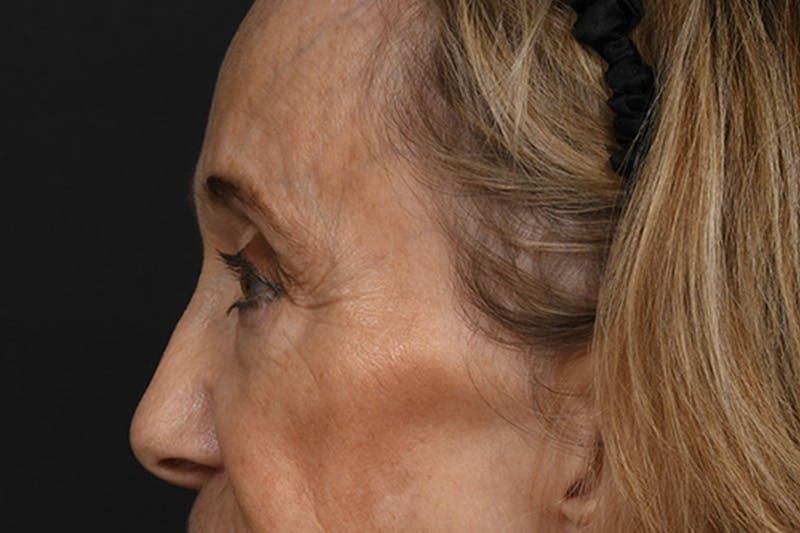 Blepharoplasty Before & After Gallery - Patient 302337 - Image 9