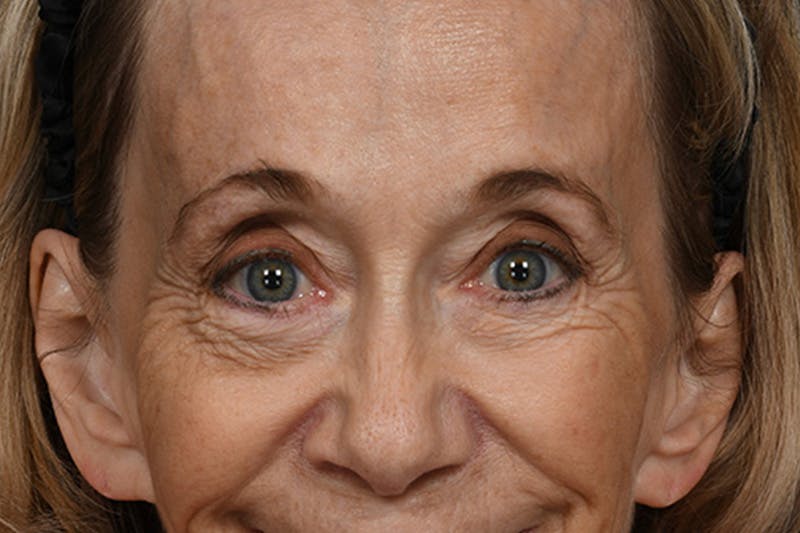 Blepharoplasty Before & After Gallery - Patient 302337 - Image 11