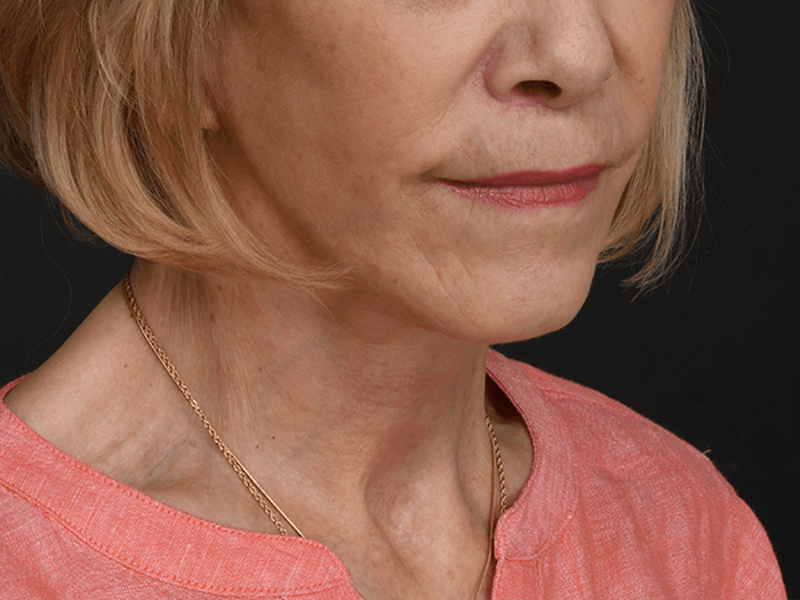 Neck Lift Before & After Gallery - Patient 278408 - Image 2