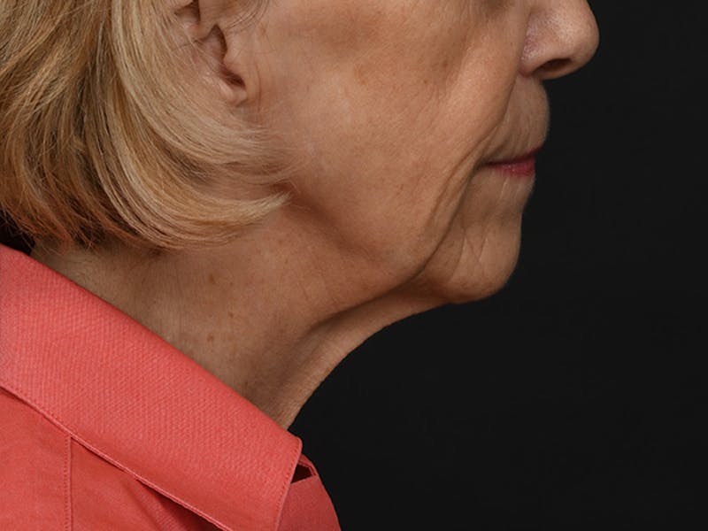 Neck Lift Before & After Gallery - Patient 278408 - Image 3