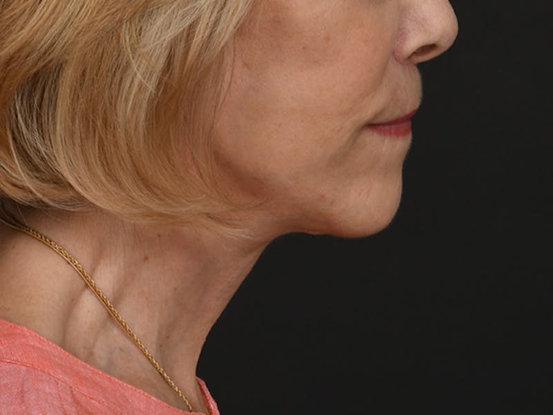 Neck Lift Before & After Gallery - Patient 278408 - Image 4