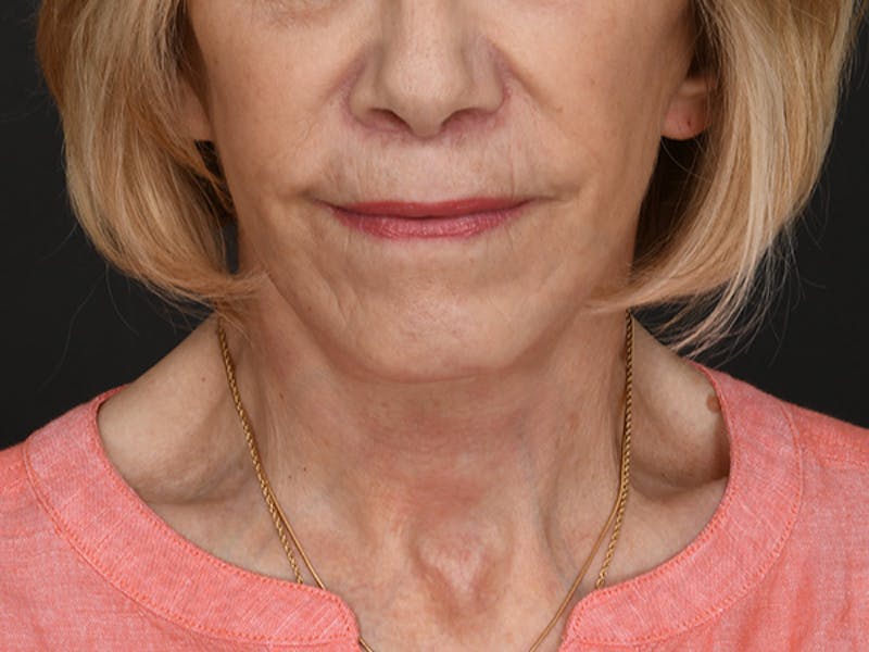 Neck Lift Before & After Gallery - Patient 278408 - Image 6