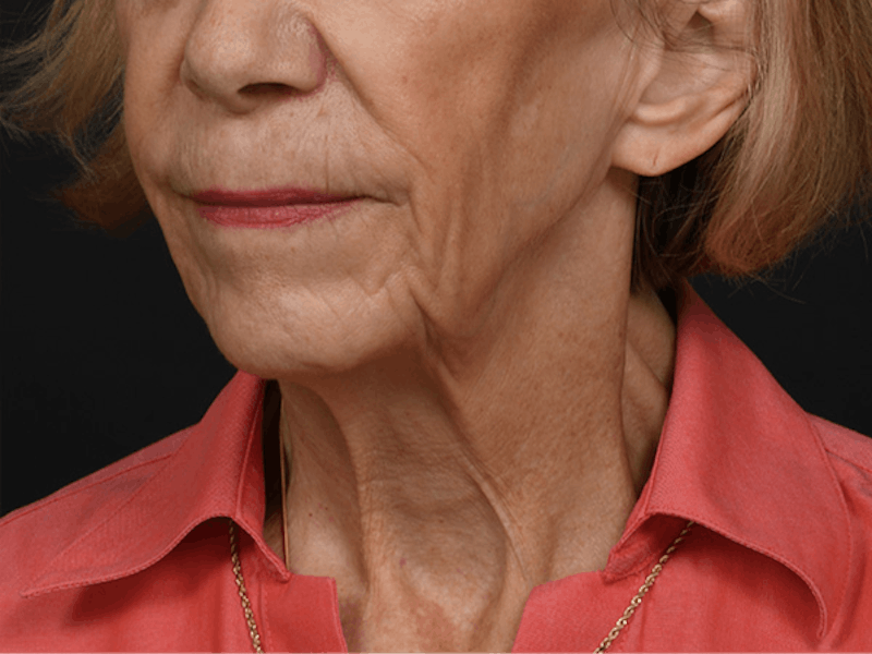 Neck Lift Before & After Gallery - Patient 278408 - Image 7