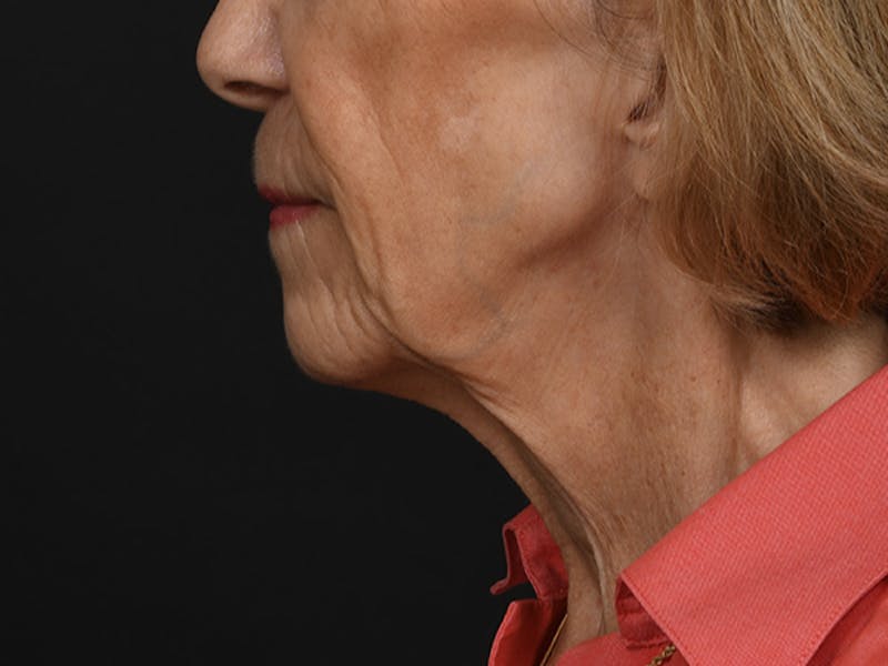 Neck Lift Before & After Gallery - Patient 278408 - Image 9